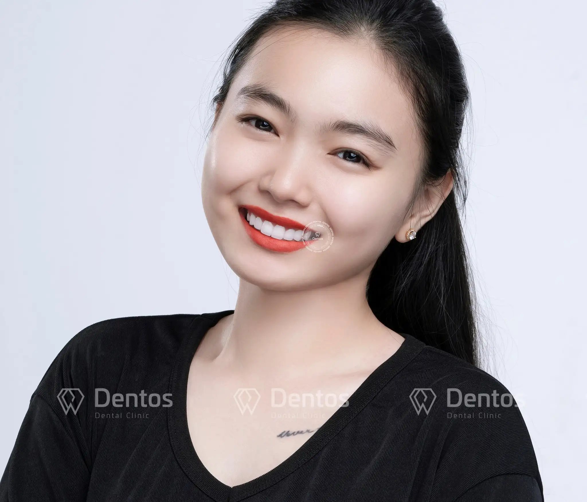 So sánh chi tiết dán Veneer và bọc răng sứ cái nào tốt hơn? 